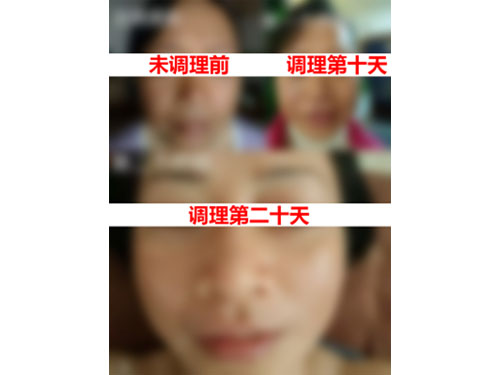 妇科闭经臟腑调理案例
