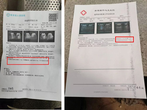 肾积水/肾结石调理案例