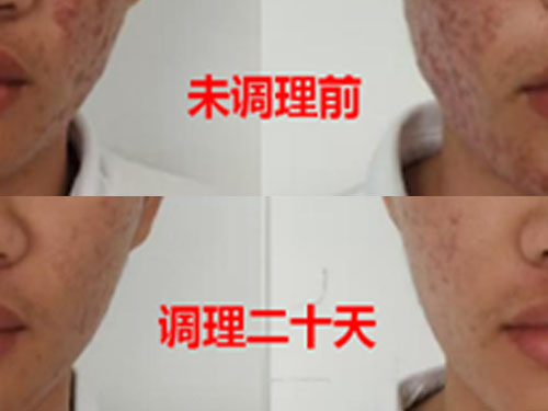 臓腑调理青春痘案例皮肤