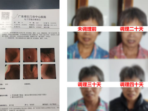 慢性胃炎臟腑调理案例