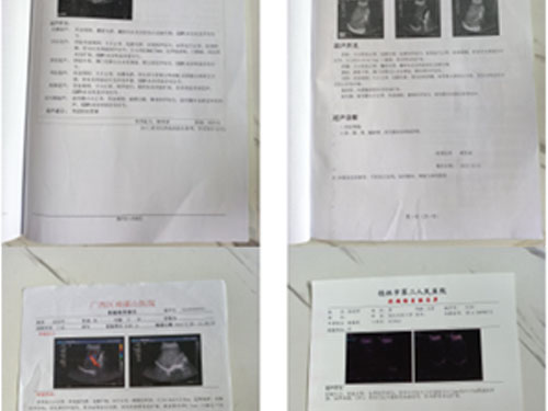 血管瘤脏腑调理案例
