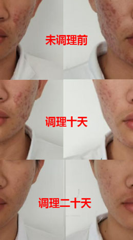 脏腑调理,臟腑调理,青春痘,皮肤科