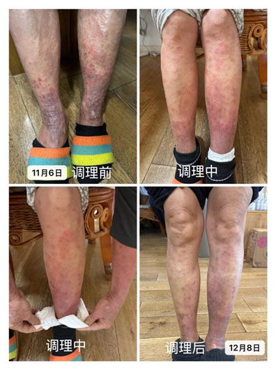 脏腑按摩,脏腑推拿,脏腑调理,臟腑调理,湿疹,皮炎