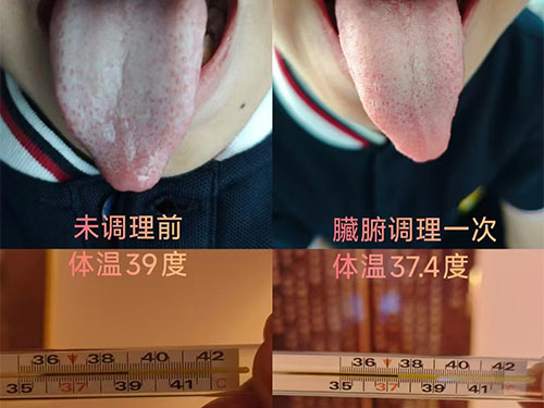 感冒发烧调理案例