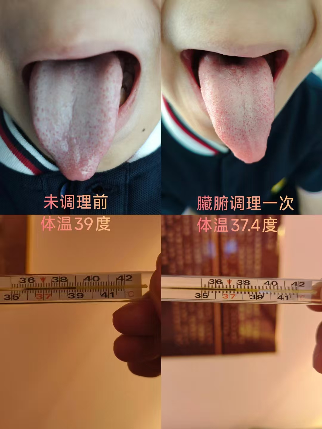 脏腑按摩,脏腑推拿,感冒,发烧